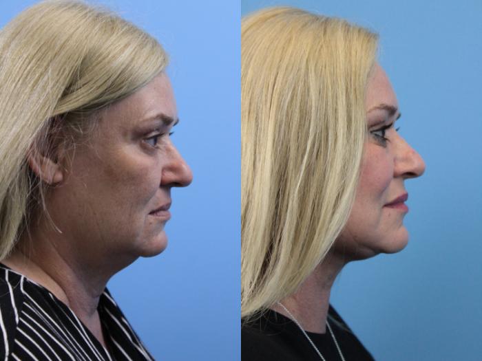 Before & After Facelift Case 167 View #2 View in West Des Moines & Ames, IA
