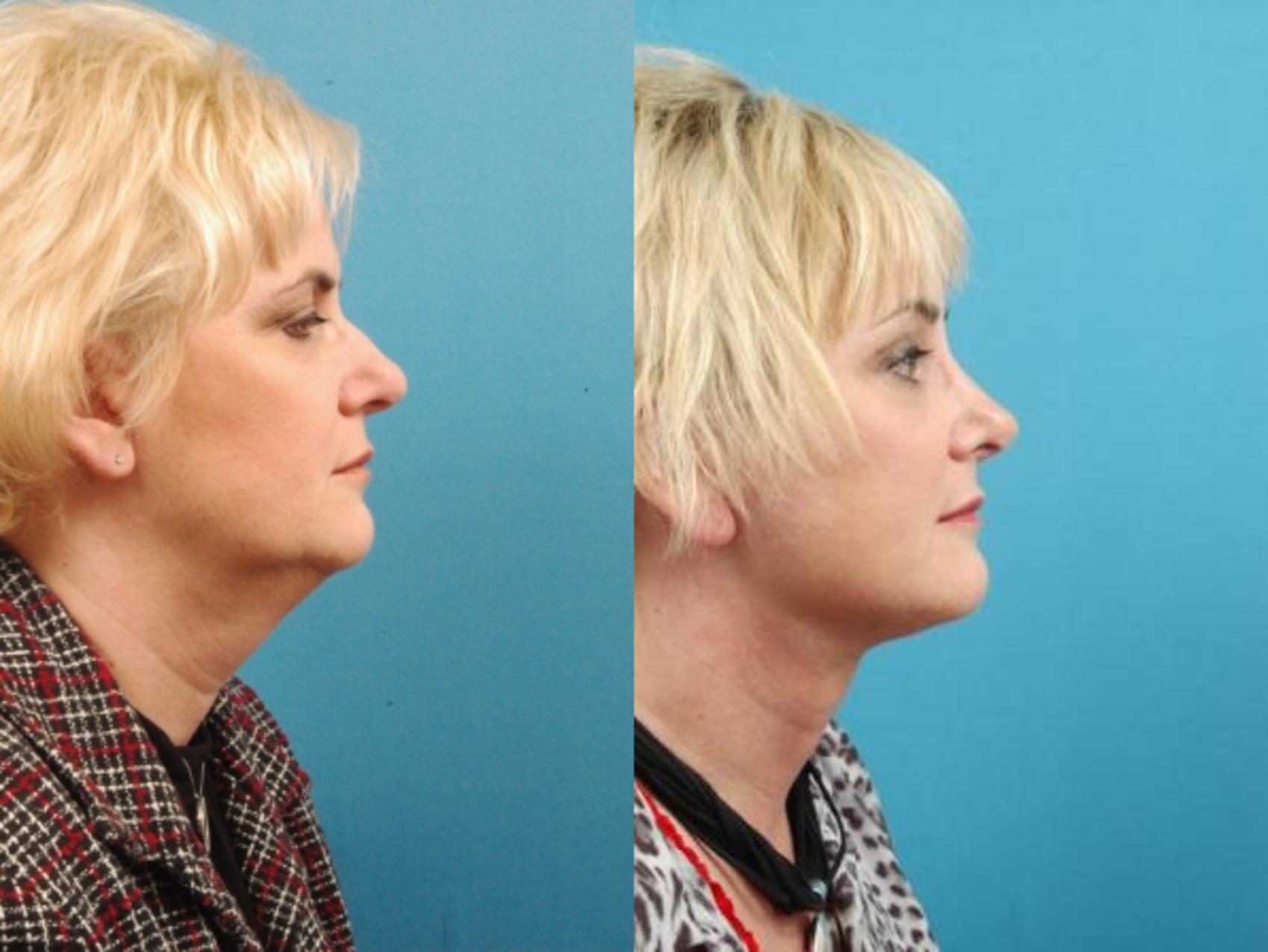 Before & After Facial Liposuction Case 17 View #1 View in West Des Moines & Ames, IA