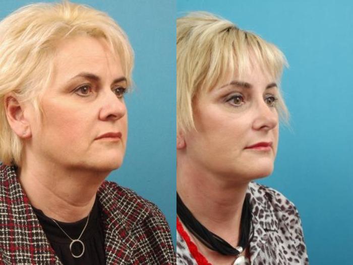 Before & After Blepharoplasty (Upper Eyelid Lift) Case 17 View #2 View in West Des Moines & Ames, IA