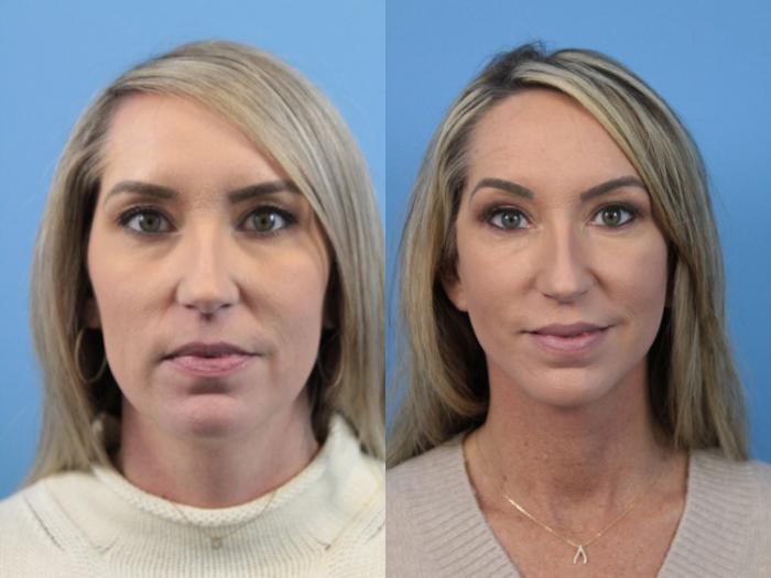 Before & After Facial Liposuction Case 170 View #1 View in West Des Moines & Ames, IA