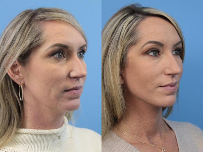 Before & After Facial Liposuction Case 170 View #2 View in West Des Moines & Ames, IA