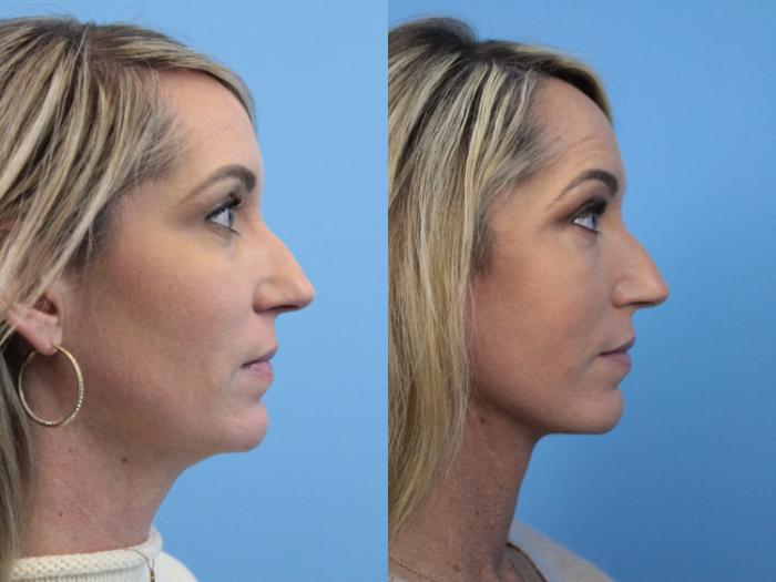 Before & After Facelift Case 170 View #3 View in West Des Moines & Ames, IA