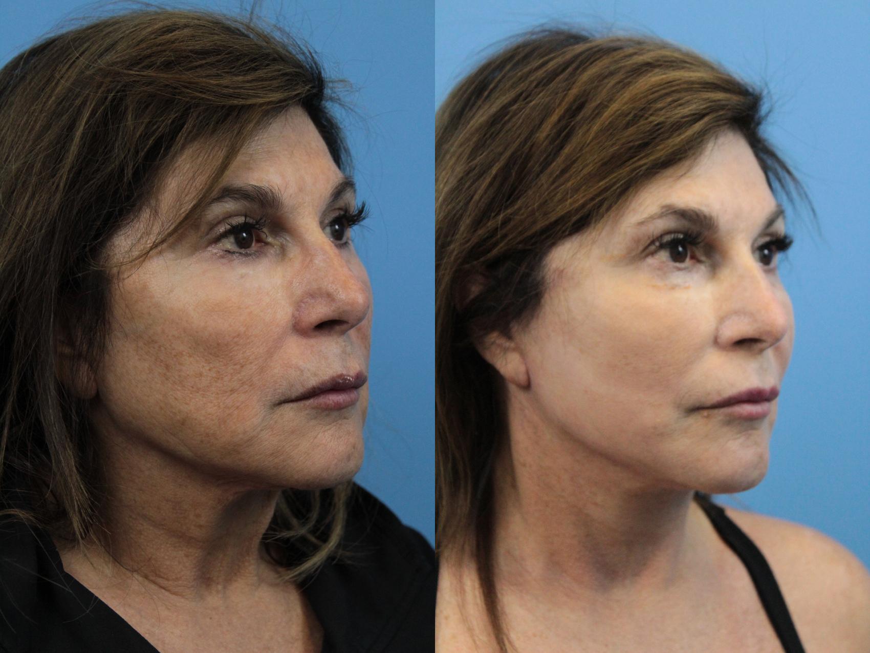 Before & After Facelift Case 185 View #1 View in West Des Moines & Ames, IA