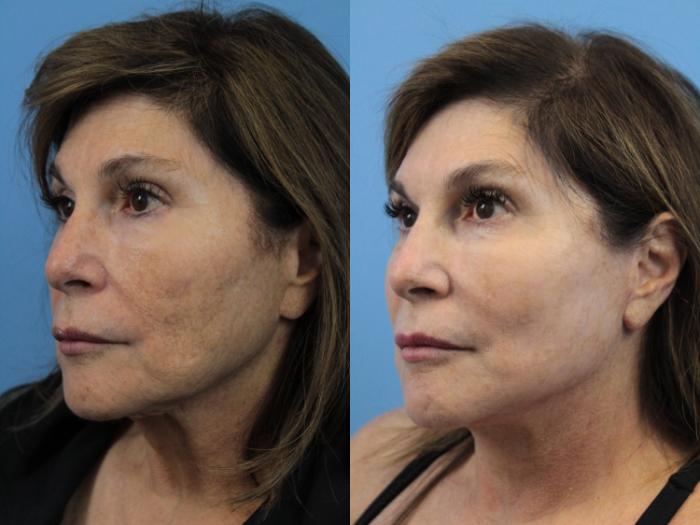 Before & After Facelift Case 185 View #2 View in West Des Moines & Ames, IA