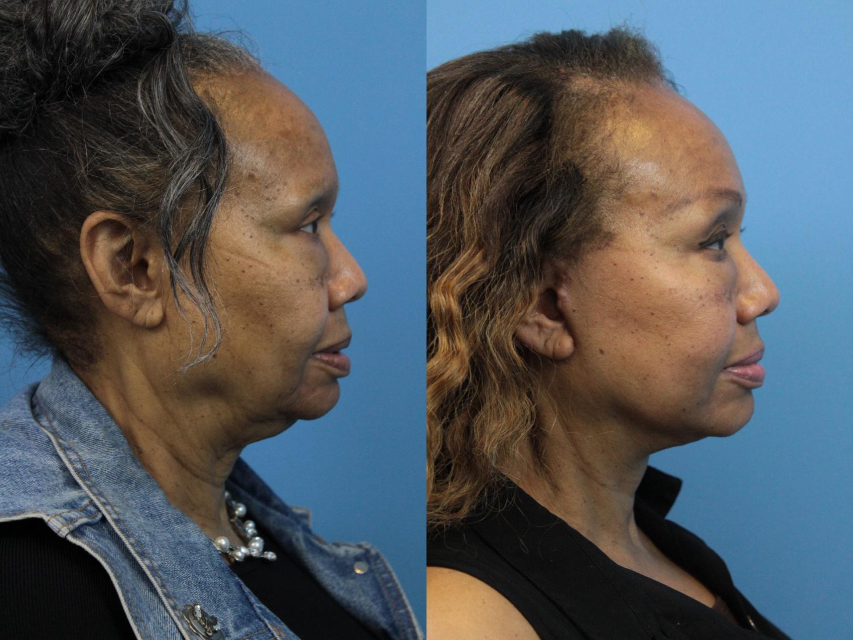 Before & After Facelift Case 187 View #2 View in West Des Moines & Ames, IA