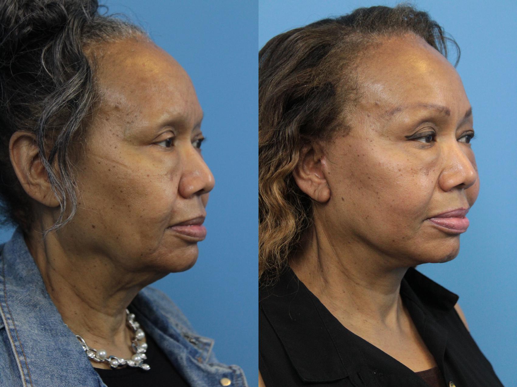 Before & After Facelift Case 187 View #4 View in West Des Moines & Ames, IA