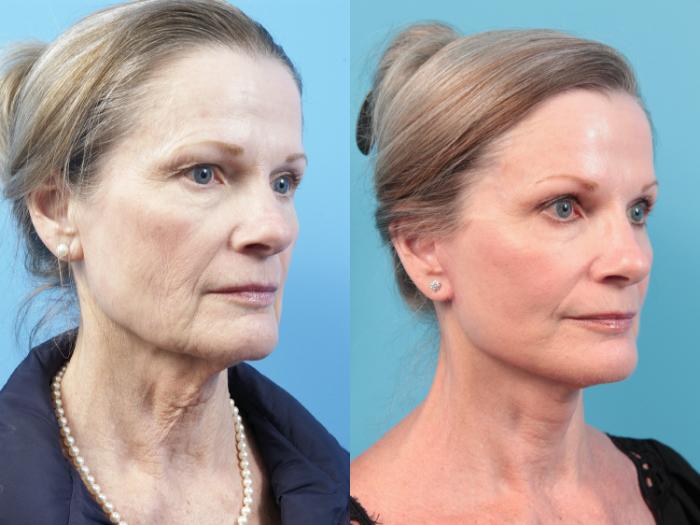 Facelift Before And After Pictures Case 19 West Des Moines Ia Koch And Carlisle Plastic