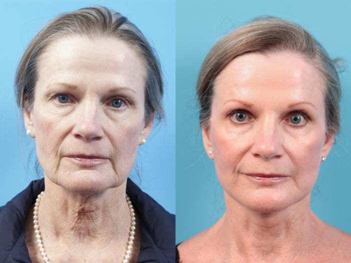 Before & After Facelift Case 19 View #2 View in West Des Moines & Ames, IA