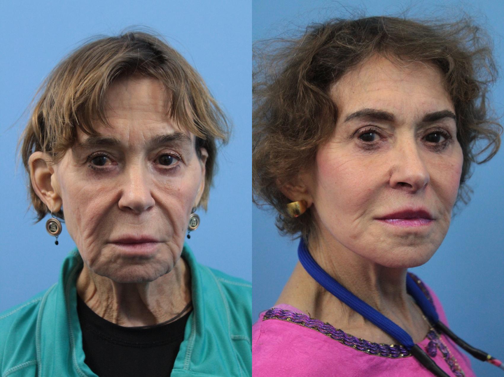 Before & After Blepharoplasty (Upper Eyelid Lift) Case 192 Front View in West Des Moines & Ames, IA