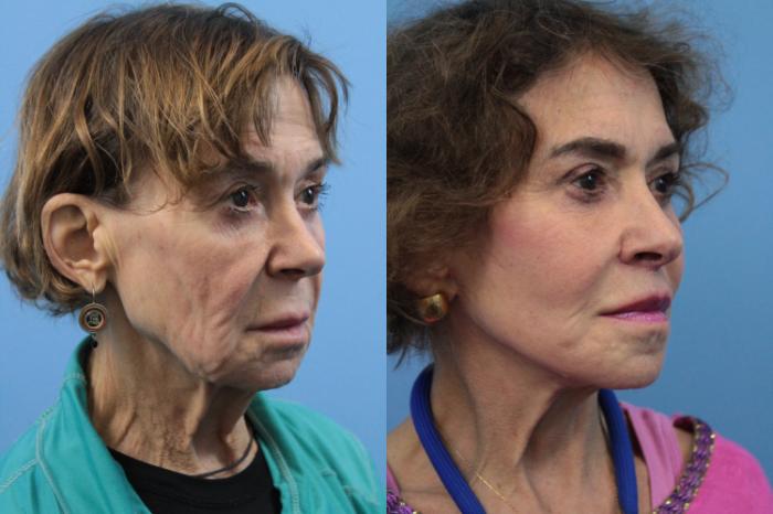 Before & After Facelift Case 192 Right Oblique View in West Des Moines, IA