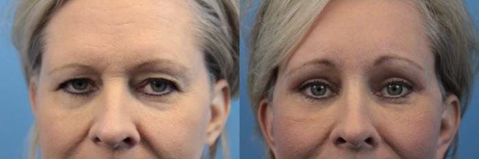 Before & After Blepharoplasty (Upper Eyelid Lift) Case 207 Eyes View in West Des Moines & Ames, IA