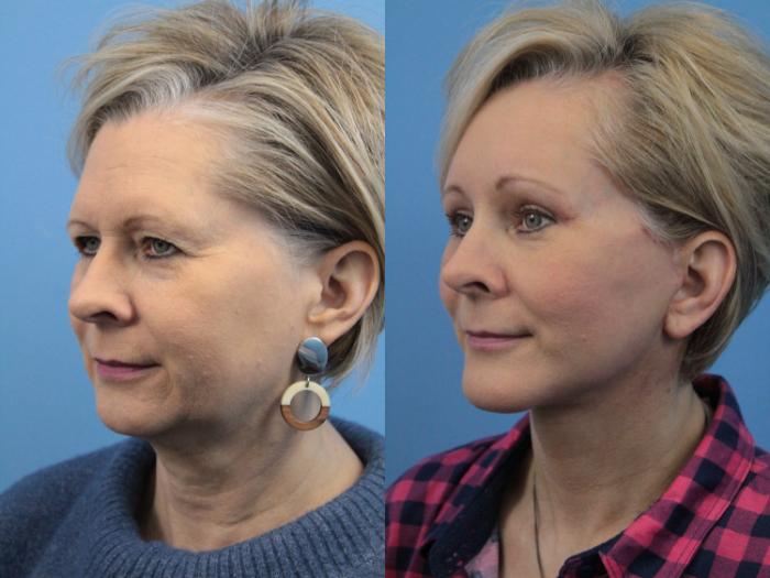 Before & After Chin Augmentation Case 207 Left Oblique View in West Des Moines & Ames, IA