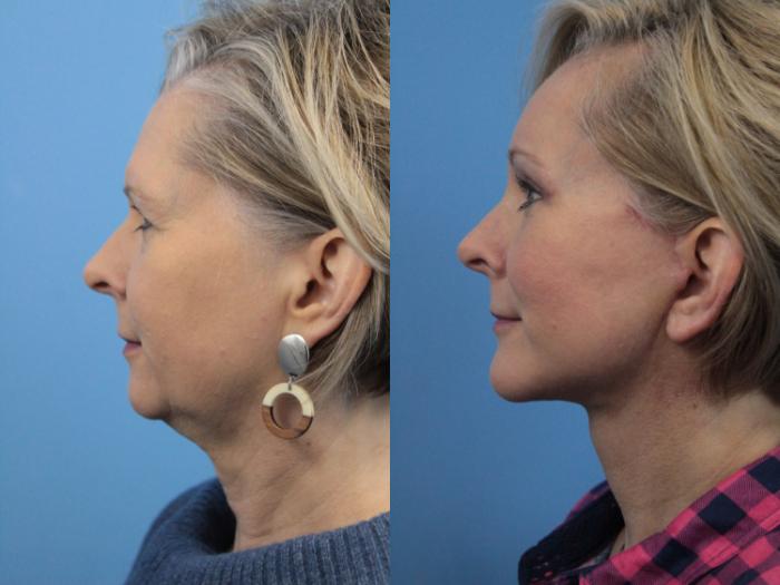 Before & After Facial Liposuction Case 207 Left Side View in West Des Moines & Ames, IA