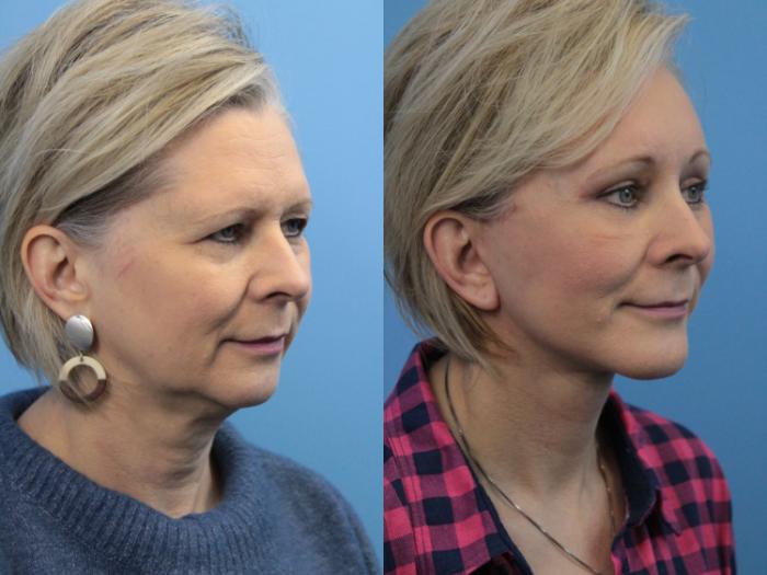 Before & After Blepharoplasty (Upper Eyelid Lift) Case 207 Right Oblique View in West Des Moines & Ames, IA