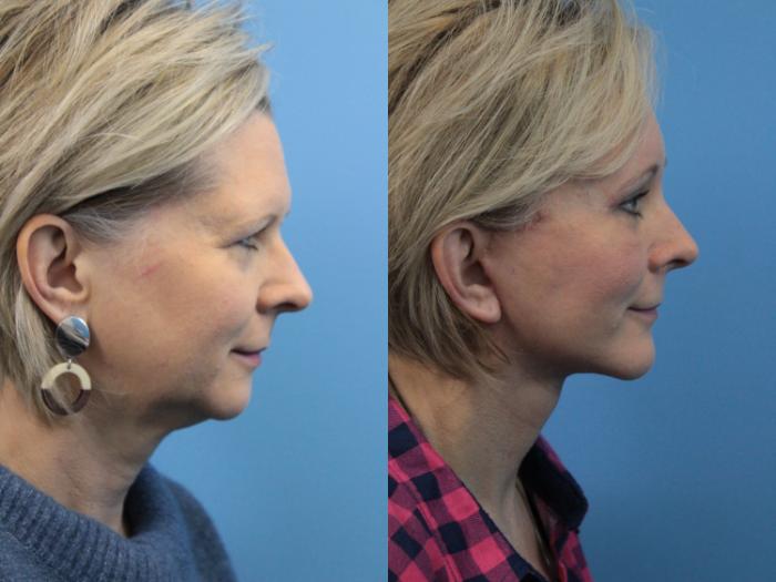 Before & After Chin Augmentation Case 207 Right Side View in West Des Moines & Ames, IA