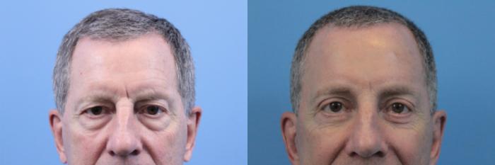 Before & After Blepharoplasty (Upper Eyelid Lift) Case 208 Eyes View in West Des Moines & Ames, IA