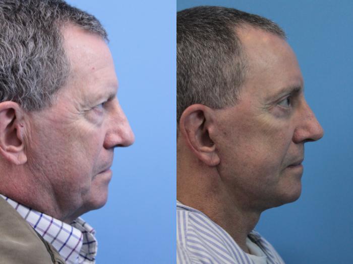 Before & After Facial Liposuction Case 208 Right Side View in West Des Moines & Ames, IA