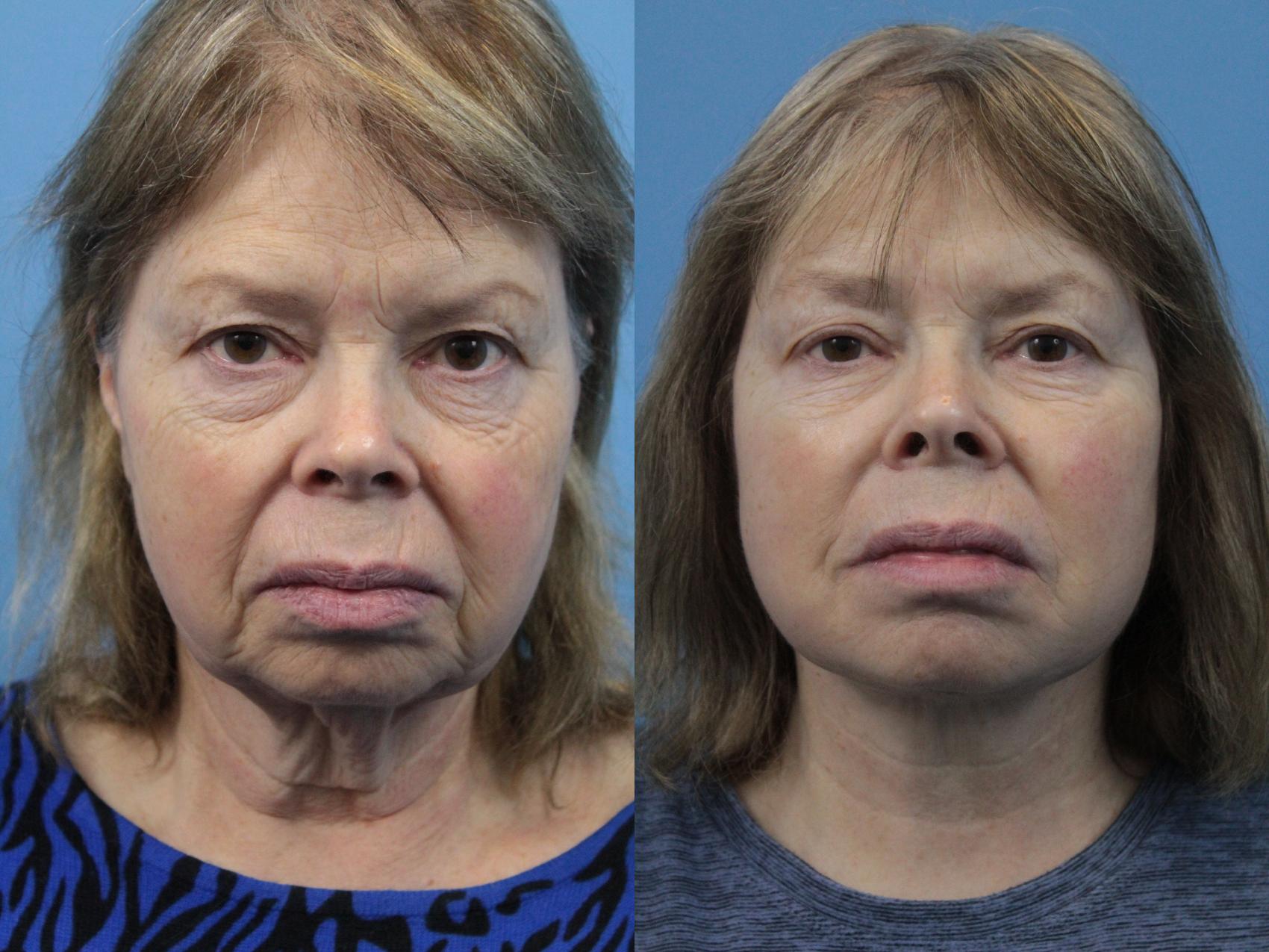 Before & After Facial Liposuction Case 218 Front View in West Des Moines & Ames, IA