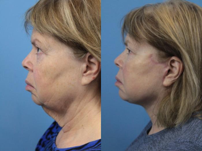Before & After Facial Liposuction Case 218 Left Side View in West Des Moines & Ames, IA