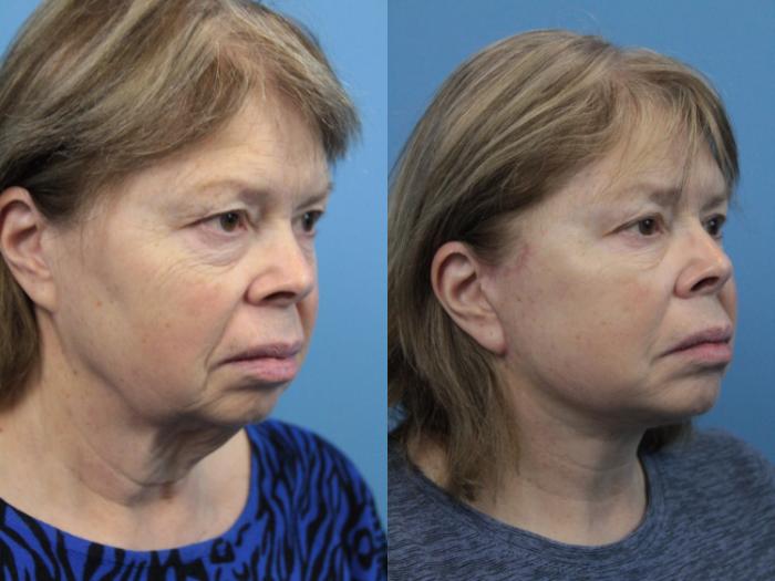 Before & After Facelift Case 218 Right Oblique View in West Des Moines & Ames, IA