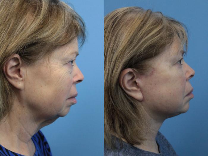 Before & After Facelift Case 218 Right Side View in West Des Moines & Ames, IA