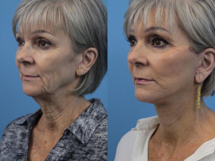 Before & After Facial Liposuction Case 220 Left Oblique View in West Des Moines & Ames, IA