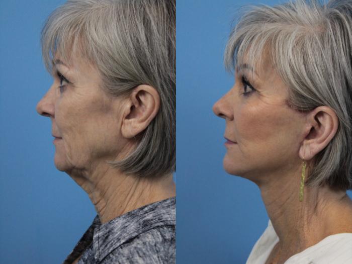 Before & After Facial Liposuction Case 220 Left Side View in West Des Moines & Ames, IA