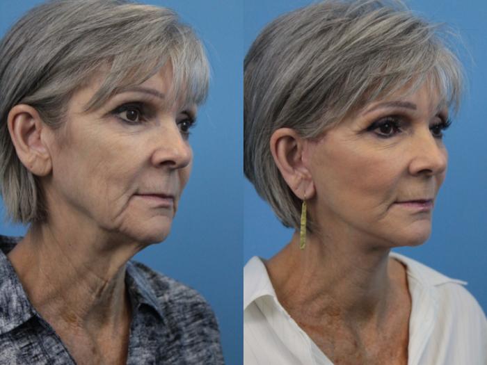 Before & After Facelift Case 220 Right Oblique View in West Des Moines & Ames, IA