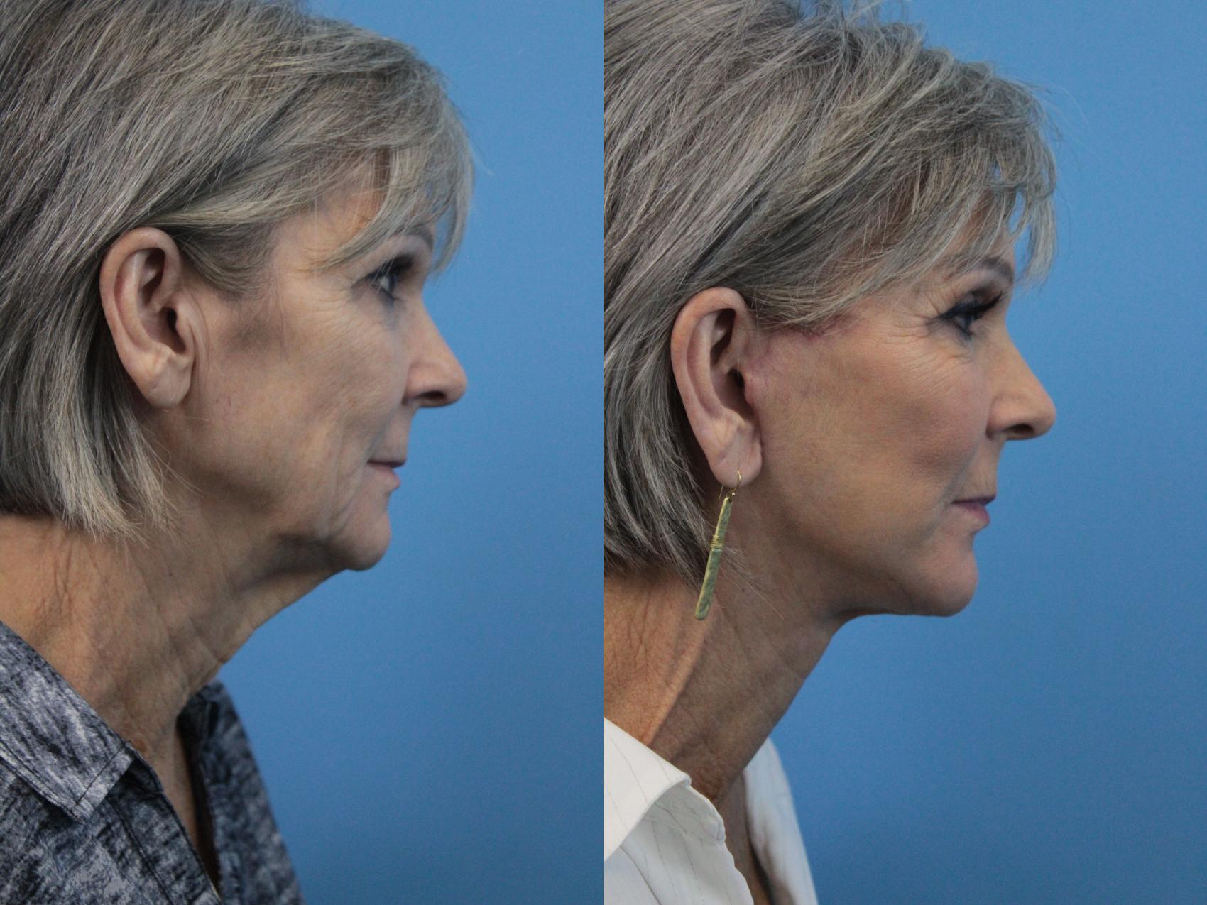 Before & After Facelift Case 220 Right Side View in West Des Moines & Ames, IA