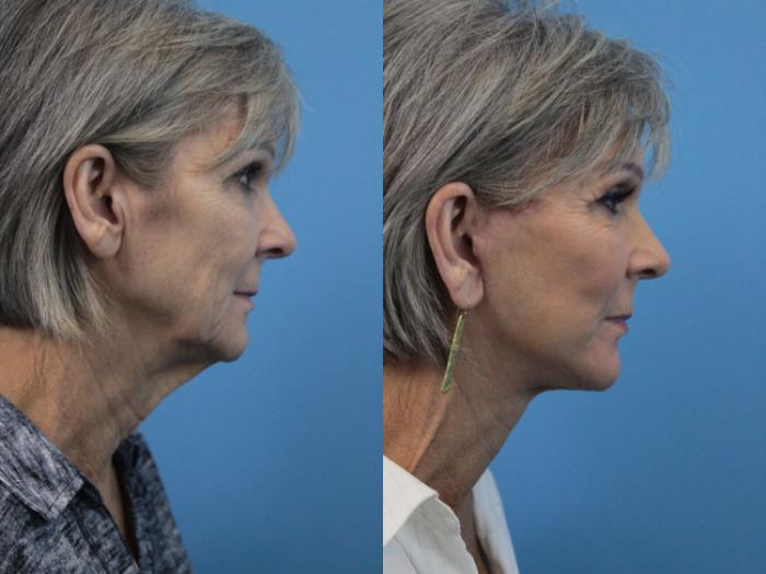 Before & After Facial Liposuction Case 220 Right Side View in West Des Moines, IA