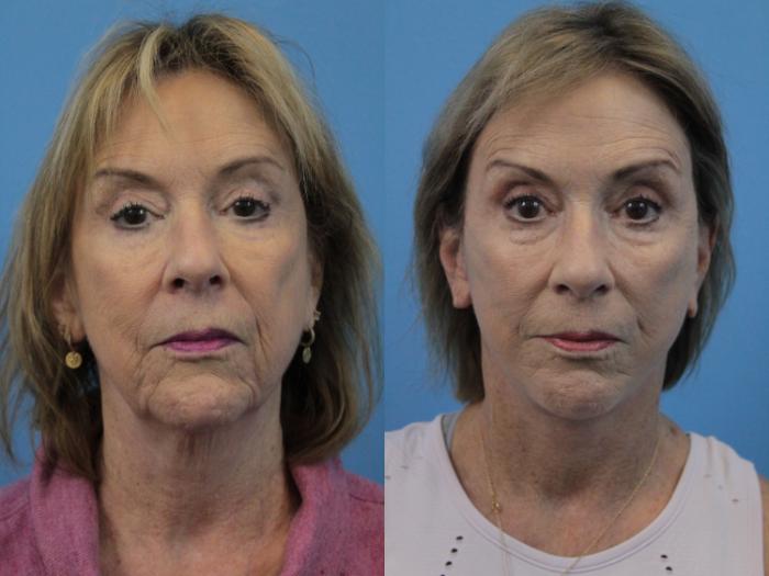 Before & After Facial Liposuction Case 223 Front View in West Des Moines & Ames, IA