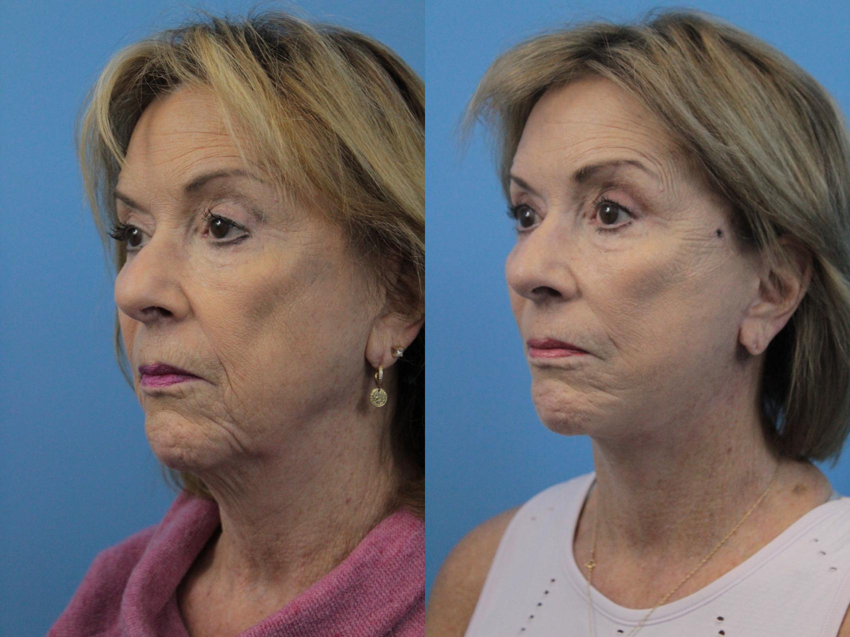 Before & After Facial Liposuction Case 223 Left Oblique View in West Des Moines, IA