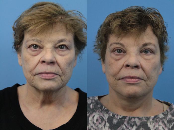 Before & After Blepharoplasty (Upper Eyelid Lift) Case 224 Front View in West Des Moines & Ames, IA