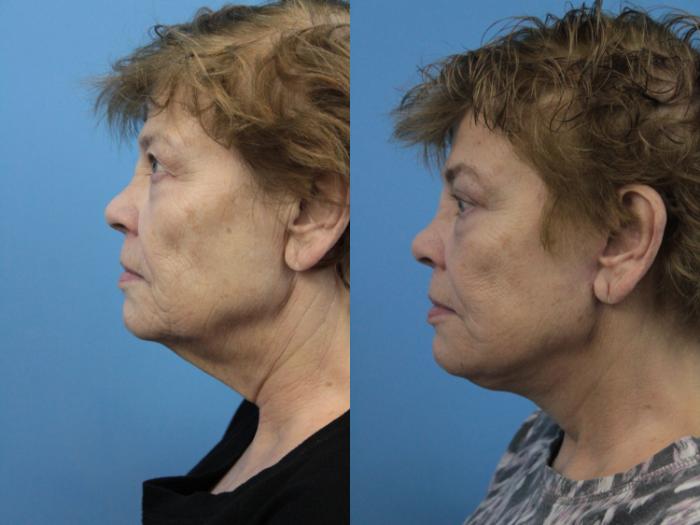 Before & After Facial Liposuction Case 224 Left Side View in West Des Moines & Ames, IA