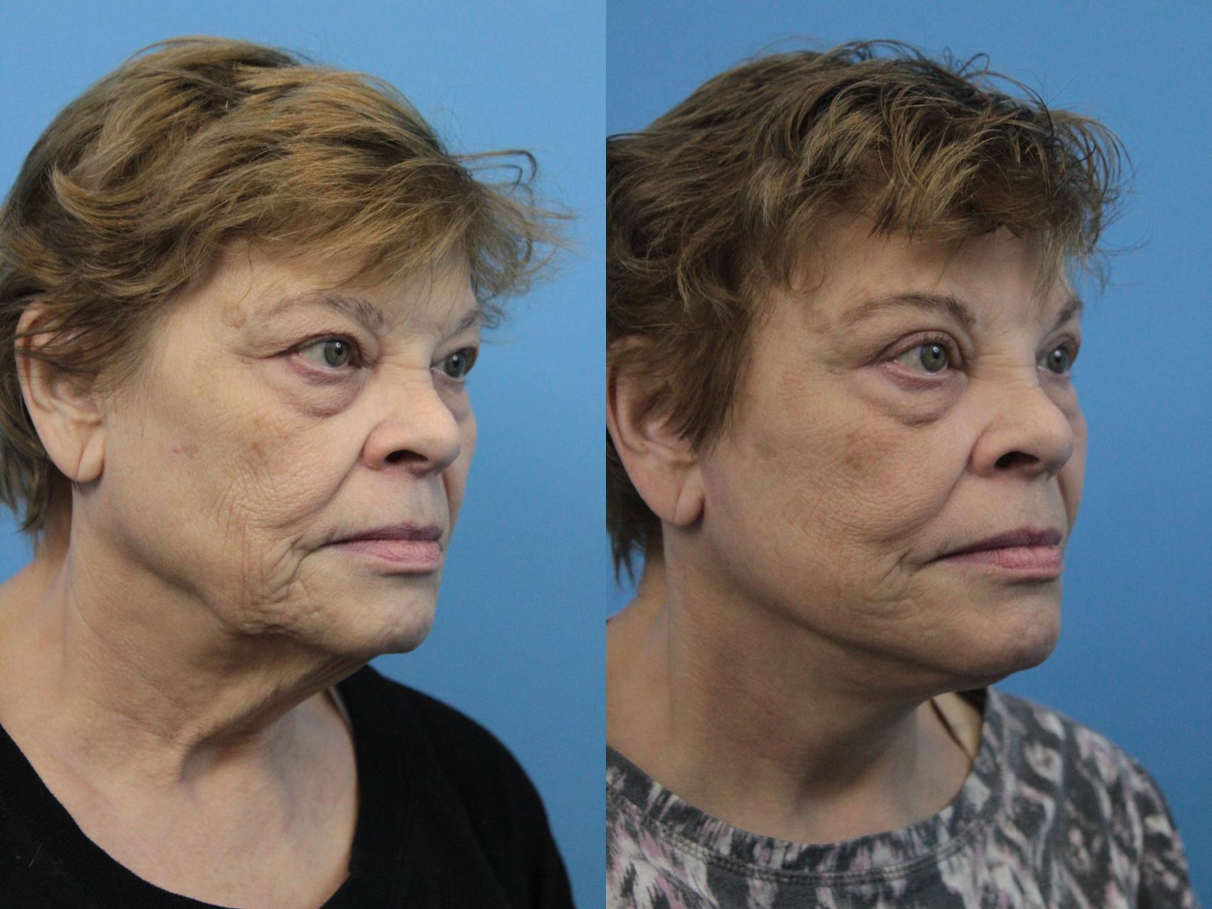 Before & After Facelift Case 224 Right Oblique View in West Des Moines & Ames, IA