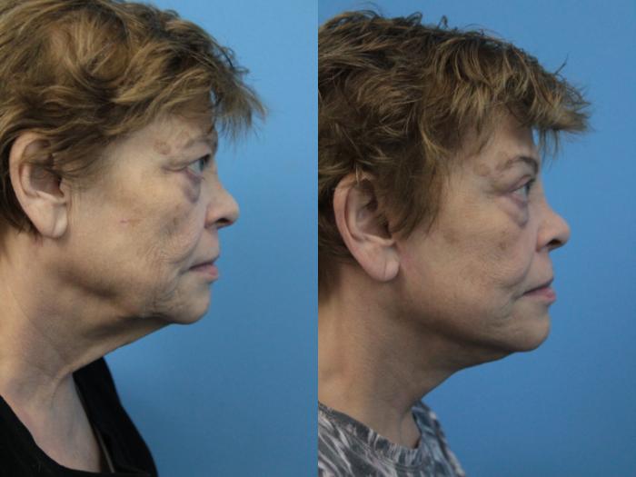 Before & After Facial Liposuction Case 224 Right Side View in West Des Moines & Ames, IA