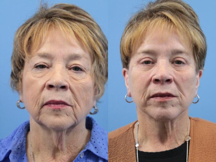 Before & After Blepharoplasty (Lower, Under Eyes) Case 233 Front View in West Des Moines, IA