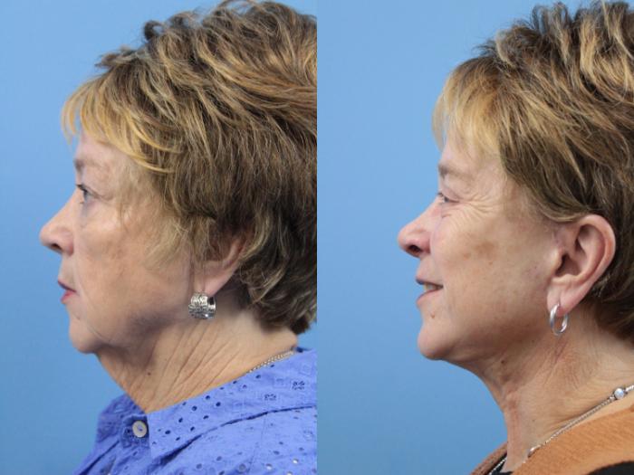Before & After Blepharoplasty (Lower, Under Eyes) Case 233 Left Side View in West Des Moines & Ames, IA