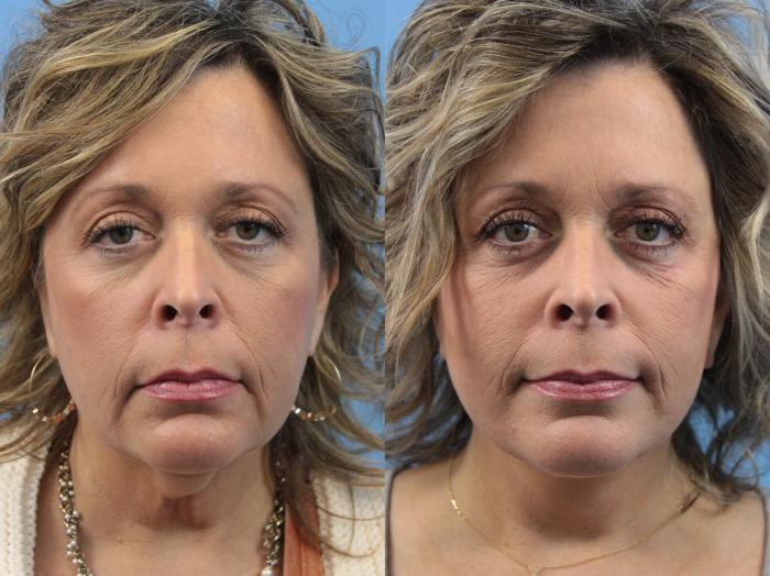 Before & After Facelift Case 234 Front View in West Des Moines & Ames, IA