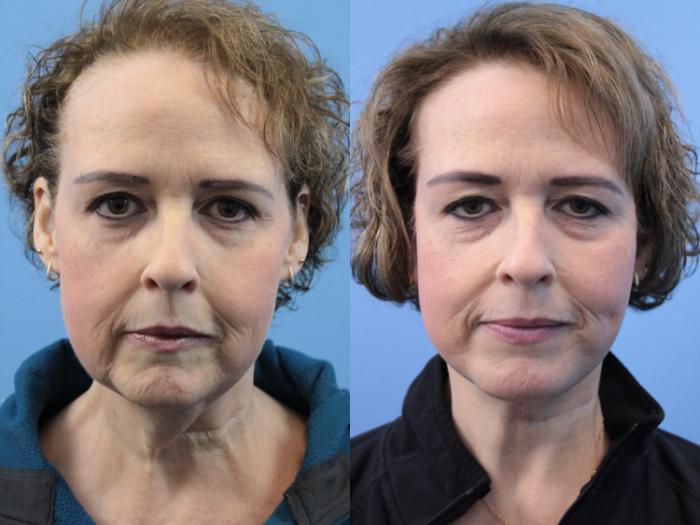 Before & After Facelift Case 236 Front View in West Des Moines & Ames, IA