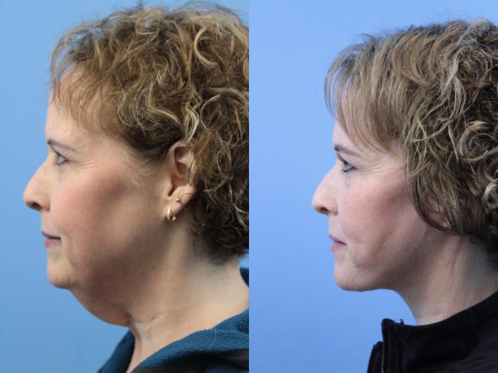 Before & After Facelift Case 236 Left Side View in West Des Moines & Ames, IA