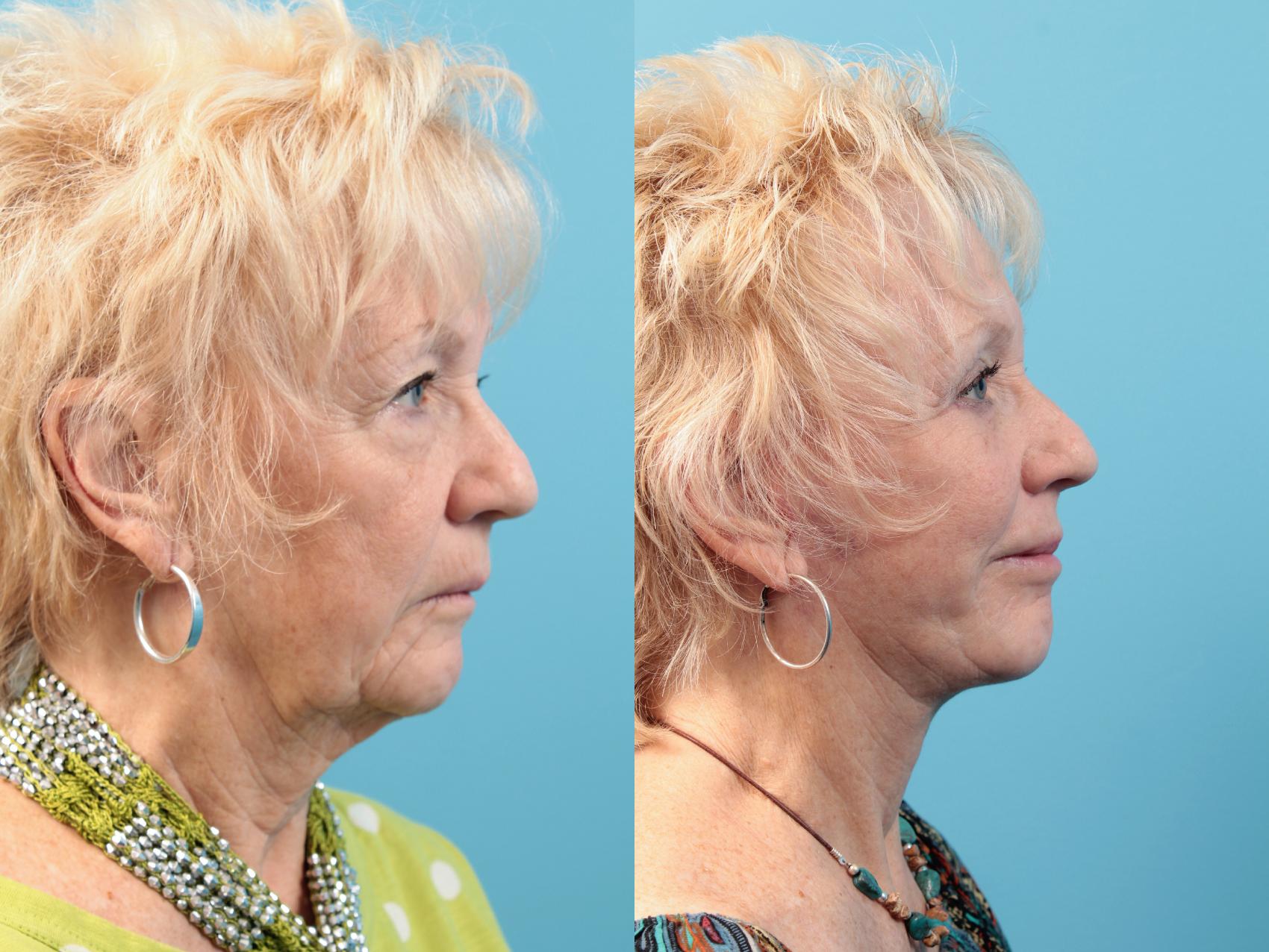 Before & After Facial Liposuction Case 25 View #1 View in West Des Moines, IA