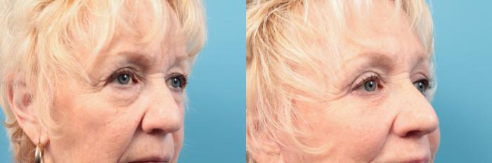 Before & After Facelift Case 25 View #2 View in West Des Moines & Ames, IA