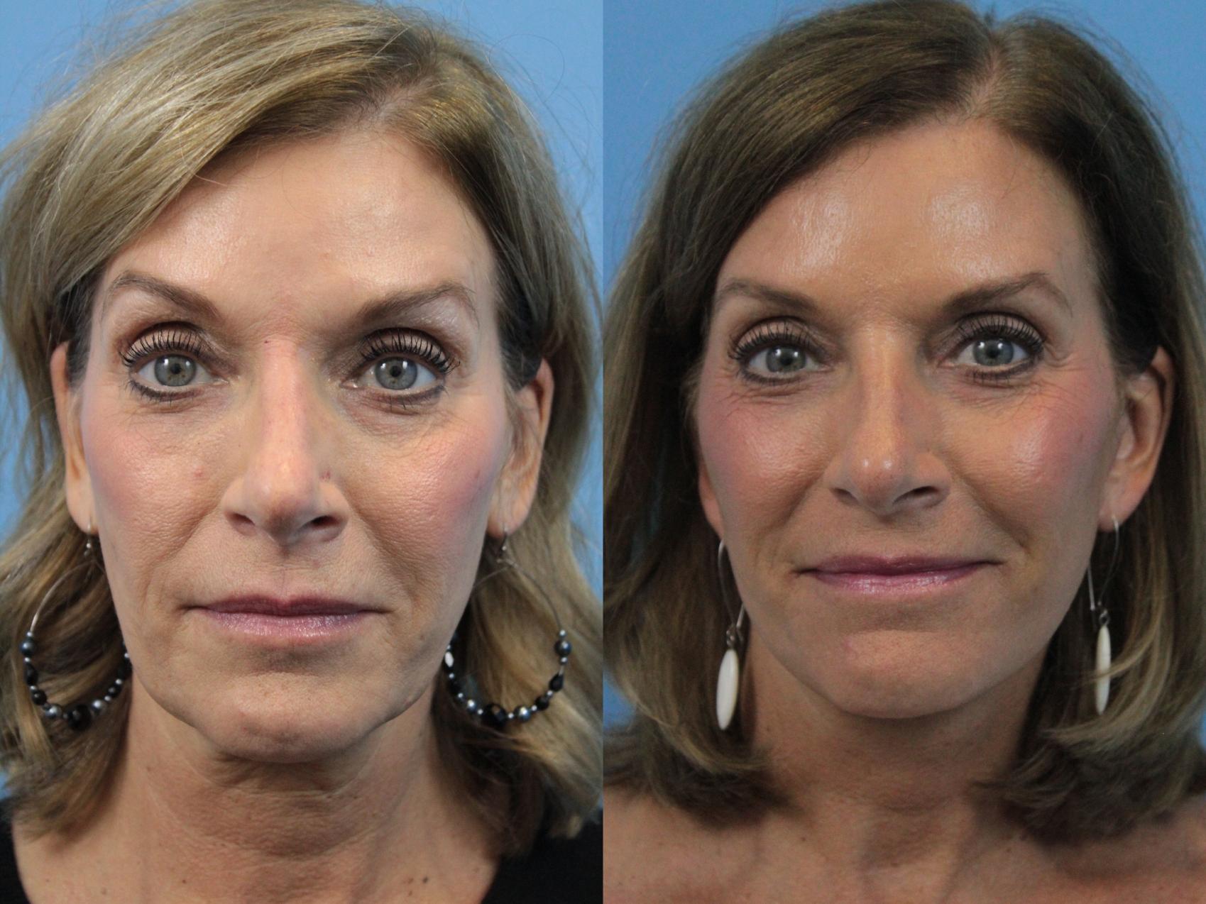 Before & After Facelift Case 272 Front View in West Des Moines & Ames, IA