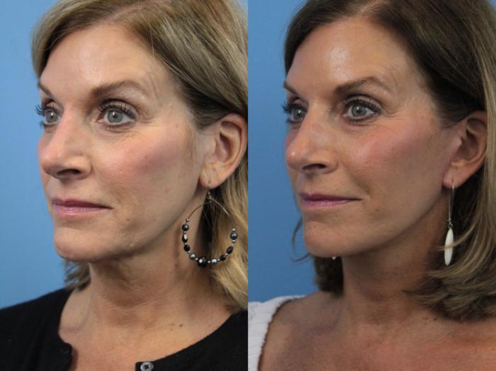 Before & After Facial Liposuction Case 272 Left Oblique View in West Des Moines & Ames, IA