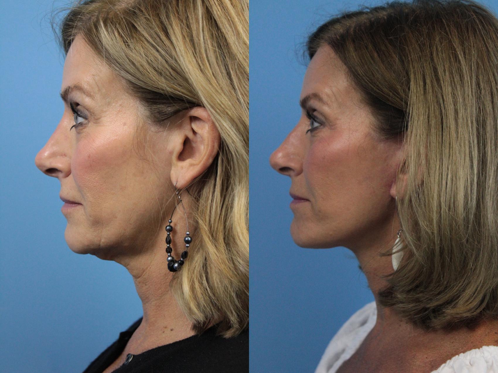 Before & After Facelift Case 272 Left Side View in West Des Moines & Ames, IA