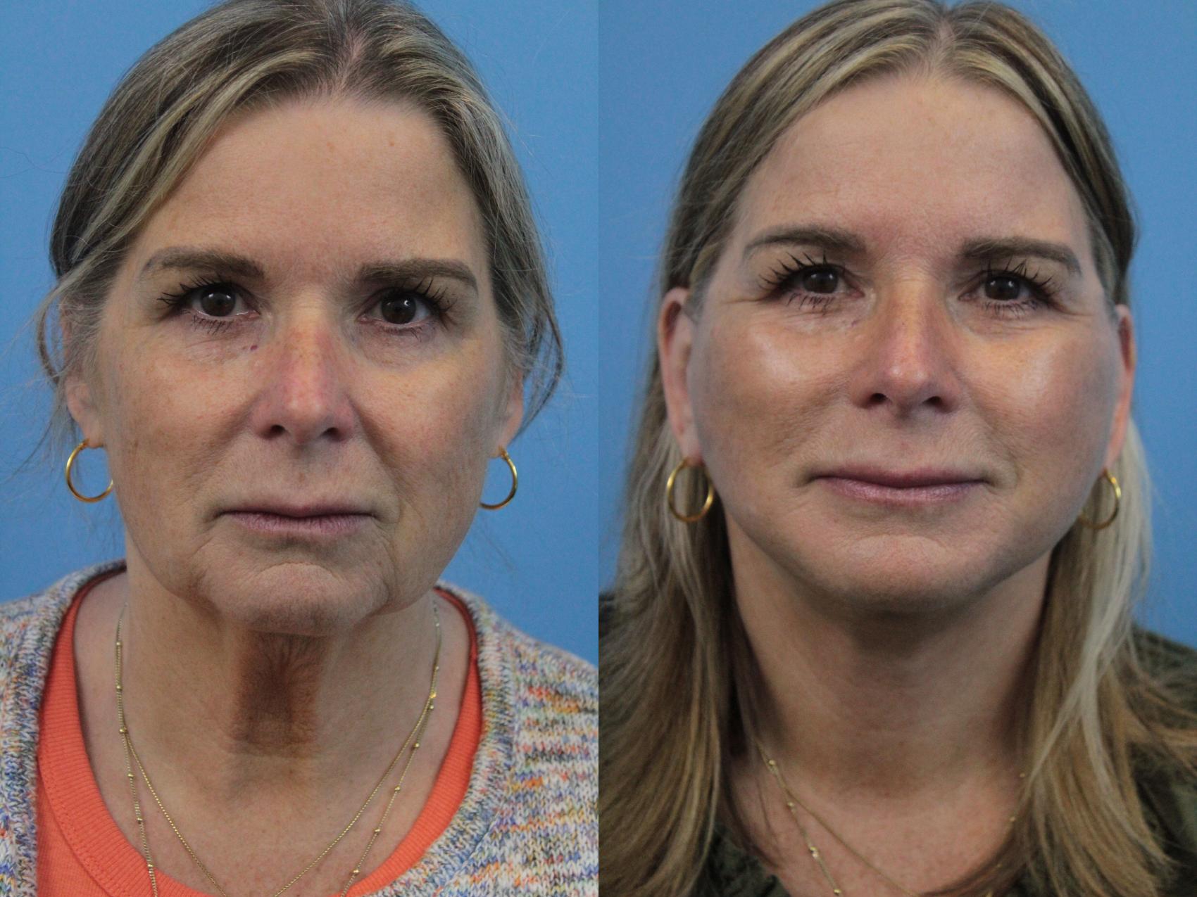 Before & After Facelift Case 281 Front View in West Des Moines & Ames, IA