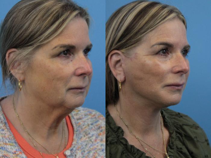 Before & After Facial Liposuction Case 281 Right Oblique View in West Des Moines & Ames, IA
