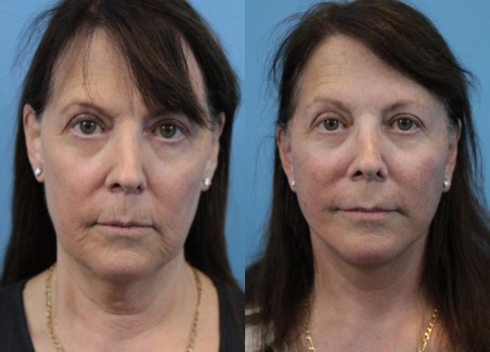 Before & After Facelift Case 295 Front View in West Des Moines & Ames, IA