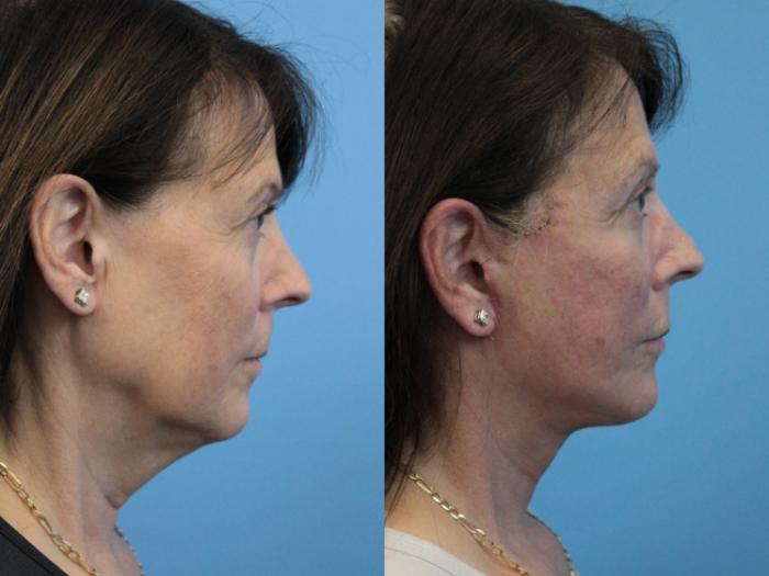 Before & After Facelift Case 295 Right Side View in West Des Moines & Ames, IA